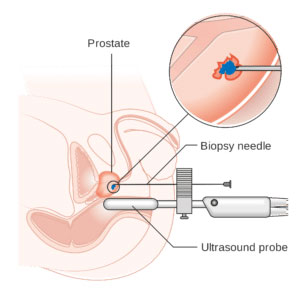biopsja-2