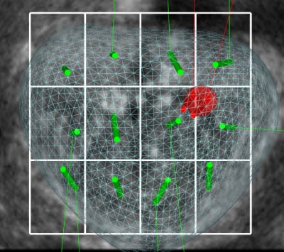 biopsja_fuzyjna_obraz_3D-2