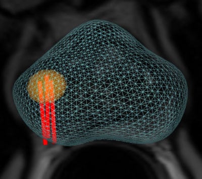 biopsja_fuzyjna_obraz_3D
