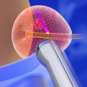 biopsja_procedura-3
