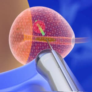 biopsja_procedura-4