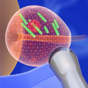 biopsja_procedura-5