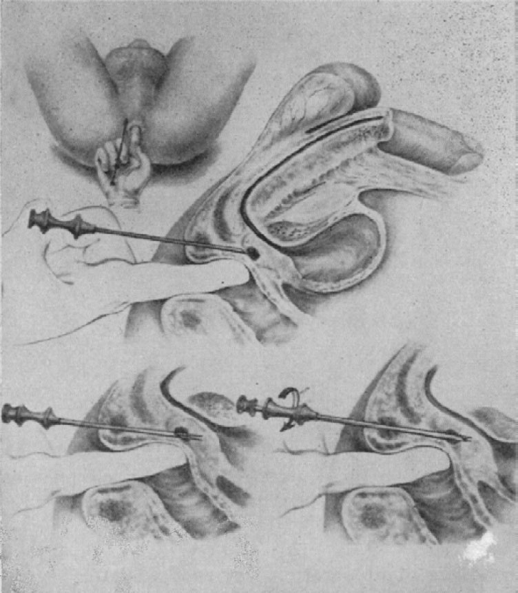 genezja_biopsji_prostaty-4