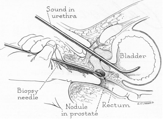 genezja_biopsji_prostaty-6