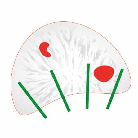 Przezodbytnicza biopsja prostaty - rysunek