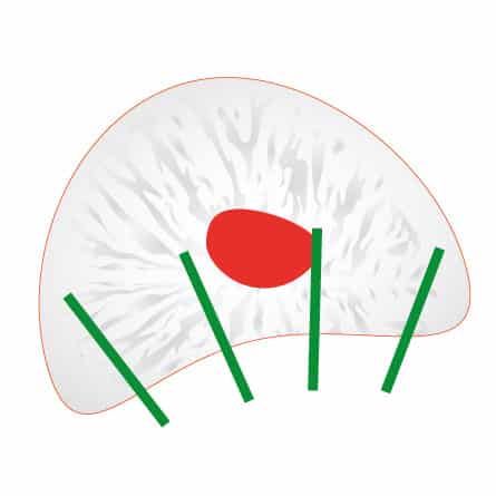 Przezodbytnicza biopsja prostaty - rysunek