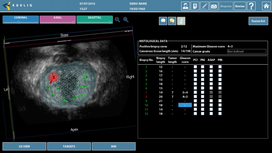 widok ekranu biopsji fuzyjnej na aparacie Koelis Trinity