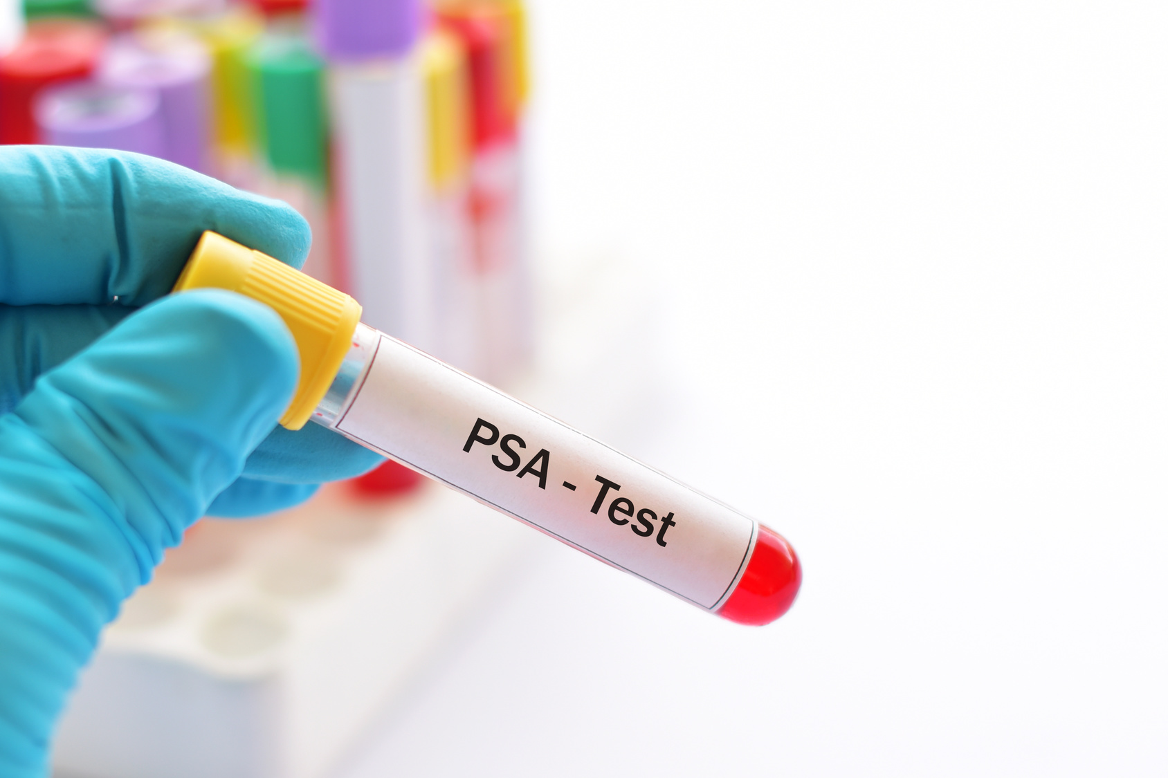 próbka krwi na badanie PSA